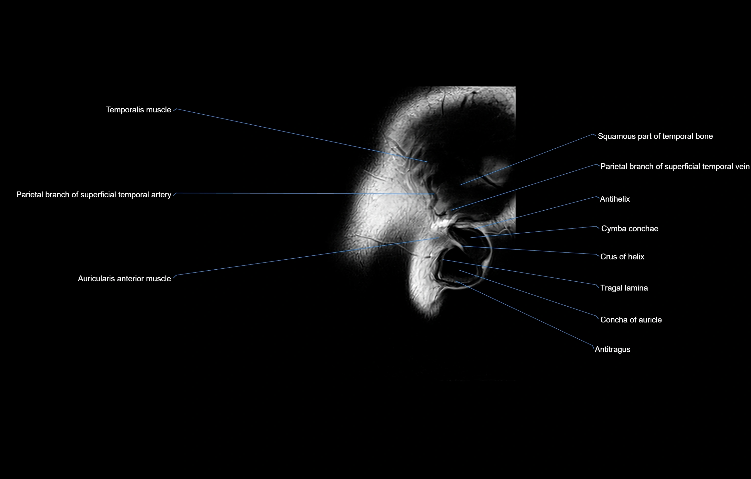 paranasal sinuses(PNS) MRI coronal  cross sectional anatomy 3T radiology  image-img-00001-00027.webp